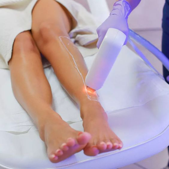 Laser Hair Removal in Montreal Safe and Effective Spa Station 5